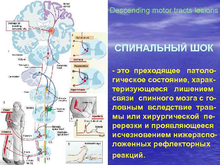 Descending motor tracts lesions СПИНАЛЬНЫЙ ШОК - это преходящее патологическое состояние, характеризующееся лишением связи