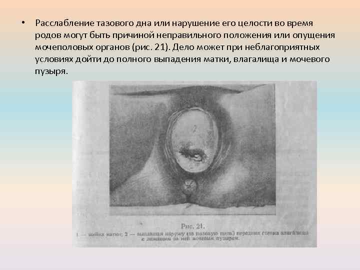  • Расслабление тазового дна или нарушение его целости во время родов могут быть