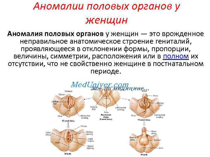 Аномалии половых органов у женщин Аномалия половых органов у женщин — это врожденное неправильное