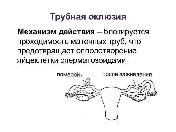 Трубная оклюзия Механизм действия – блокируется проходимость маточных труб, что предотвращает оплодотворение яйцеклетки сперматозоидами.