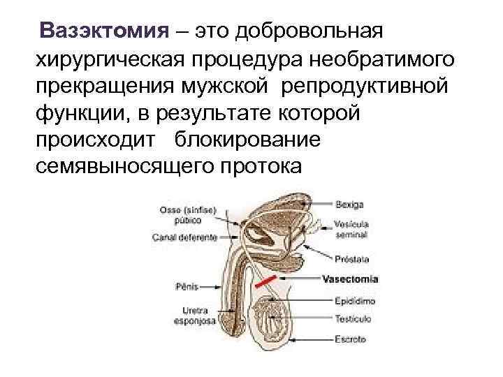 Вазэктомия – это добровольная хирургическая процедура необратимого прекращения мужской репродуктивной функции, в результате которой