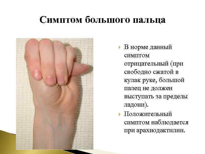 Симптом большого пальца В норме данный симптом отрицательный (при свободно сжатой в кулак руке,