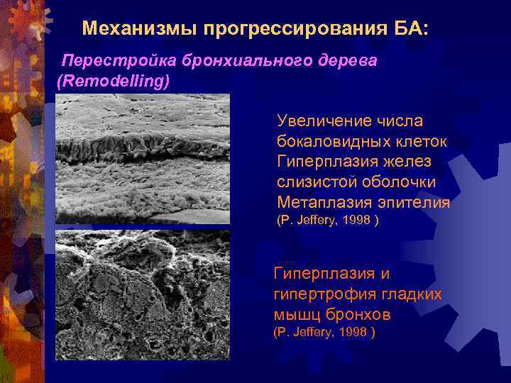 Механизмы прогрессирования БА: Перестройка бронхиального дерева (Remodelling) Увеличение числа бокаловидных клеток Гиперплазия желез слизистой