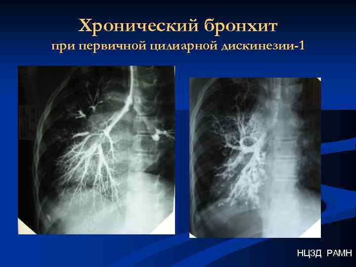 Хронический бронхит при первичной цилиарной дискинезии-1 НЦЗД РАМН 