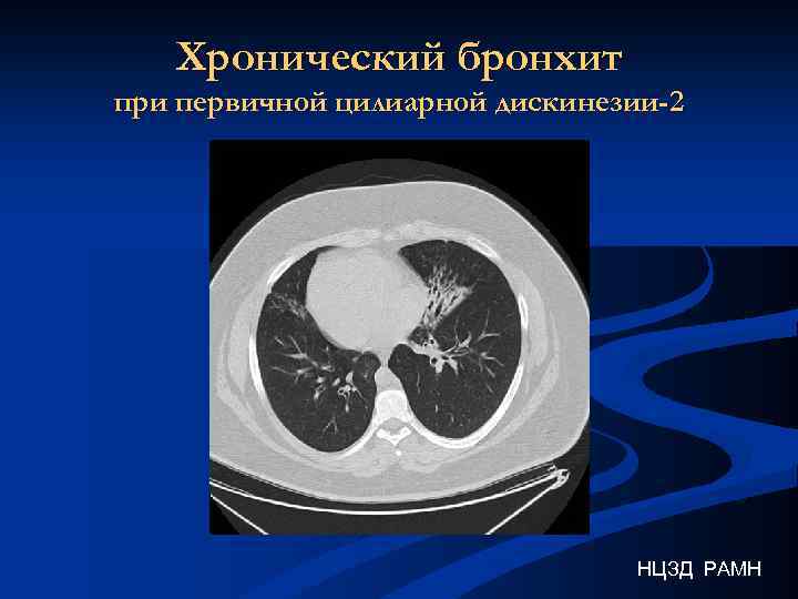 Хронический бронхит при первичной цилиарной дискинезии-2 НЦЗД РАМН 
