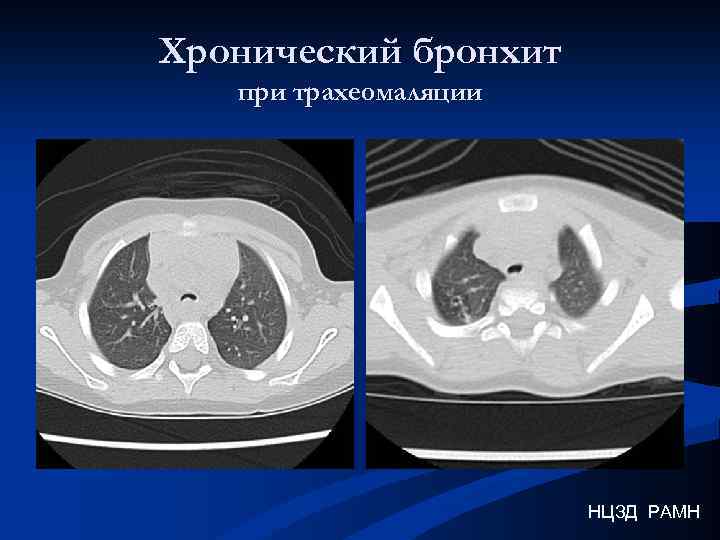 Хронический бронхит при трахеомаляции НЦЗД РАМН 