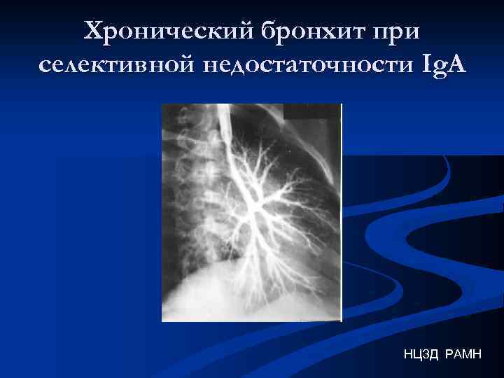 Хронический бронхит при селективной недостаточности Ig. A НЦЗД РАМН 
