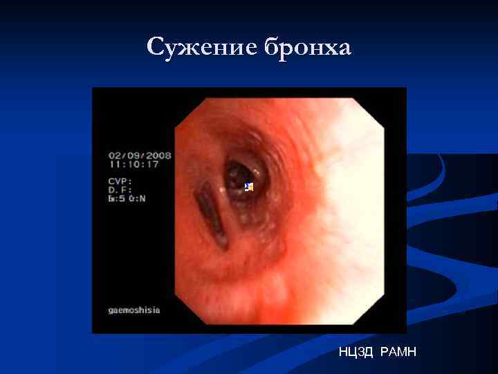Сужение бронха НЦЗД РАМН 