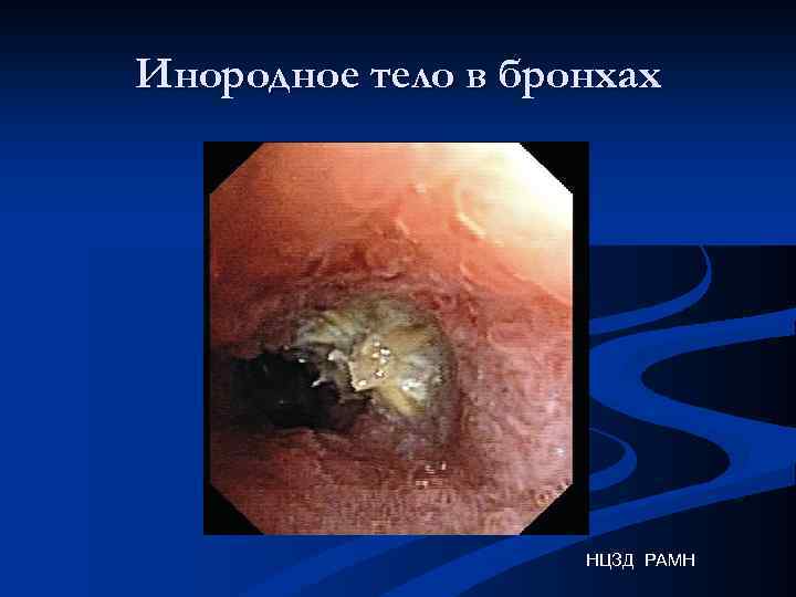 Инородное тело в бронхах НЦЗД РАМН 