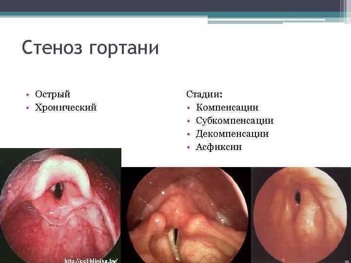 Стеноз гортани • Острый • Хронический Стадии: • Компенсации • Субкомпенсации • Декомпенсации •