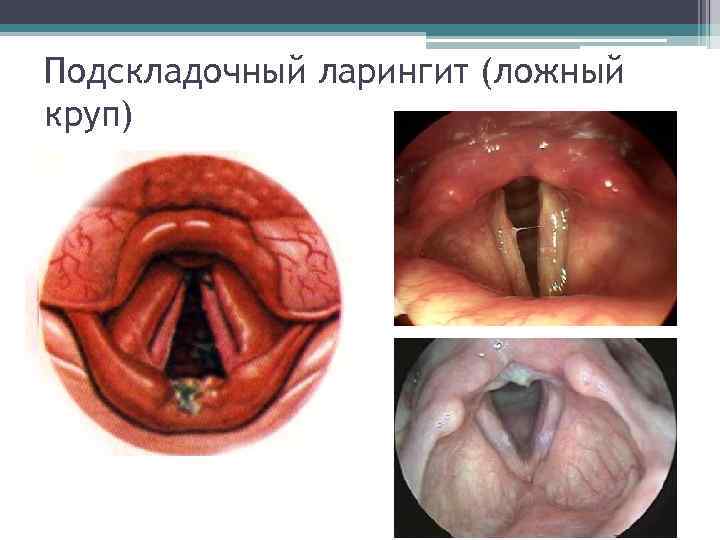 Подскладочный ларингит (ложный круп) 