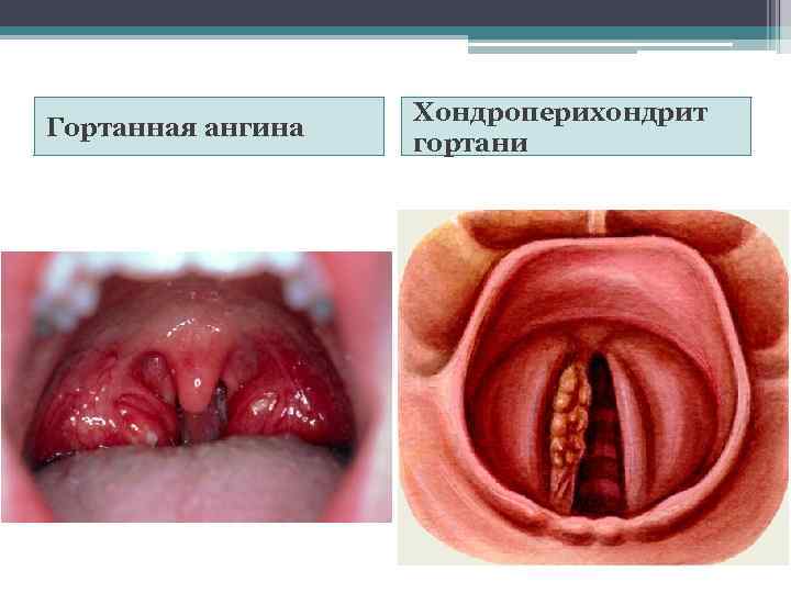 Гортанная ангина Хондроперихондрит гортани 