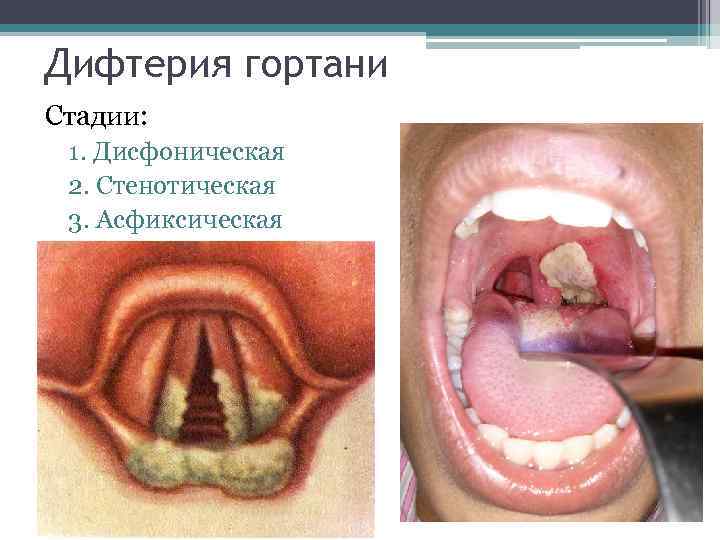 Дифтерия гортани Стадии: 1. Дисфоническая 2. Стенотическая 3. Асфиксическая 