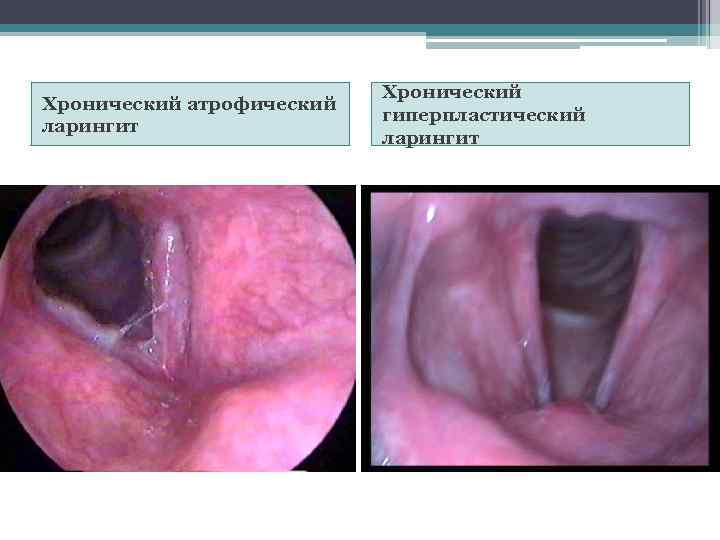 Хронический атрофический ларингит Хронический гиперпластический ларингит 