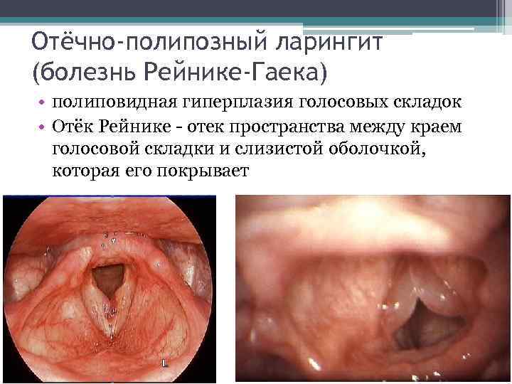 Отёчно-полипозный ларингит (болезнь Рейнике-Гаека) • полиповидная гиперплазия голосовых складок • Отёк Рейнике - отек