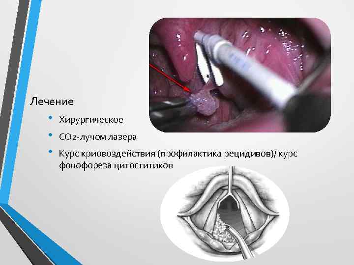 Лечение • • • Хирургическое СО 2 -лучом лазера Курс криовоздействия (профилактика рецидивов)/ курс