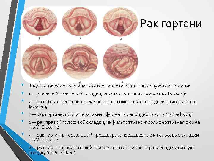 Рак гортани • • • Эндоскопическая картина некоторых злокачественных опухолей гортани: • • 3