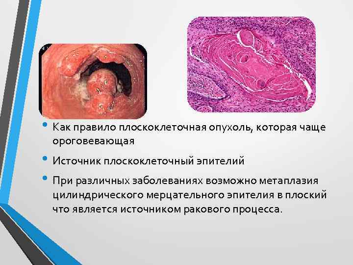  • Как правило плоскоклеточная опухоль, которая чаще ороговевающая • Источник плоскоклеточный эпителий •