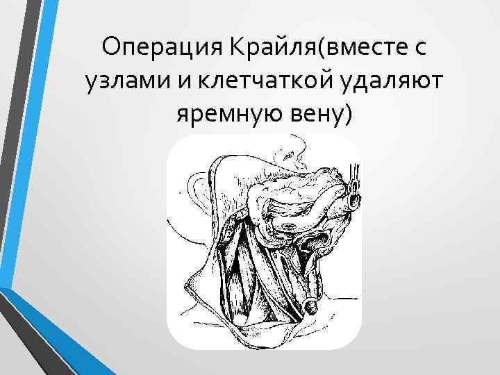 Операция Крайля(вместе с узлами и клетчаткой удаляют яремную вену) 