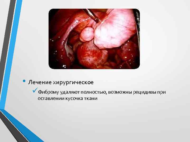  • Лечение хирургическое üФиброму удаляют полностью, возможны рецидивы при оставлении кусочка ткани 