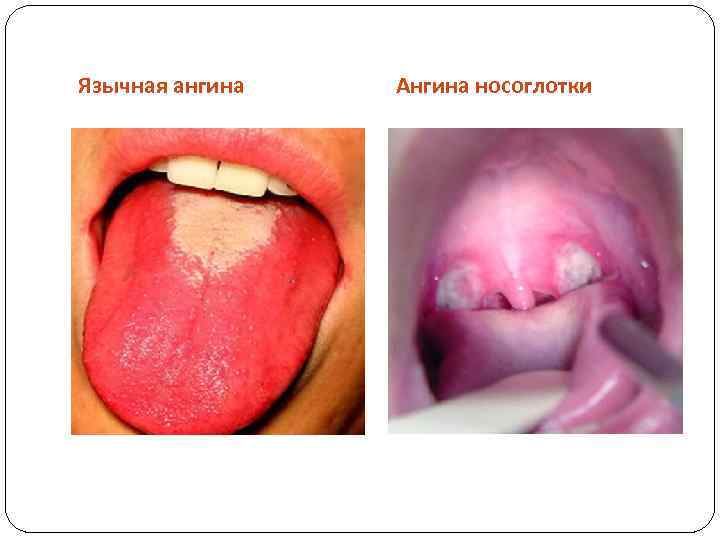 Язычная ангина Ангина носоглотки 