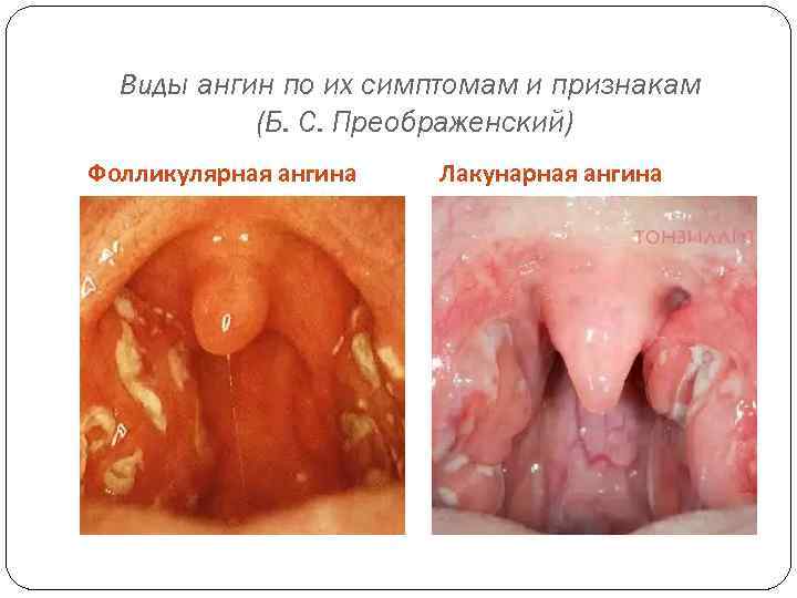 Виды ангин по их симптомам и признакам (Б. С. Преображенский) Фолликулярная ангина Лакунарная ангина