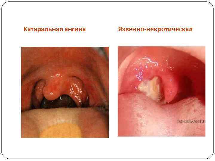 Катаральная ангина Язвенно-некротическая 