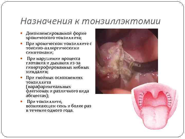 Назначения к тонзиллэктомии Декомпенсированной форме хронического тонзиллита; При хроническом тонзиллите с токсико-аллергическими симптомами; При