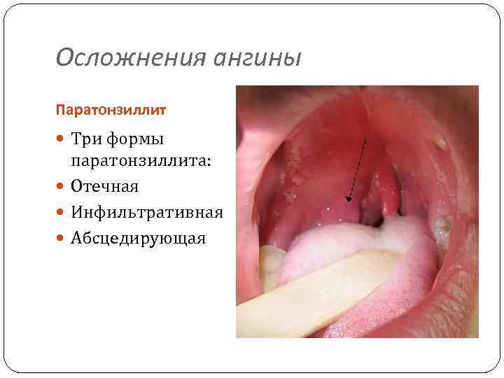 Осложнения ангины Паратонзиллит Три формы паратонзиллита: Отечная Инфильтративная Абсцедирующая 