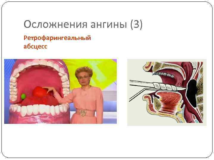 Осложнения ангины (3) Ретрофарингеальный абсцесс 