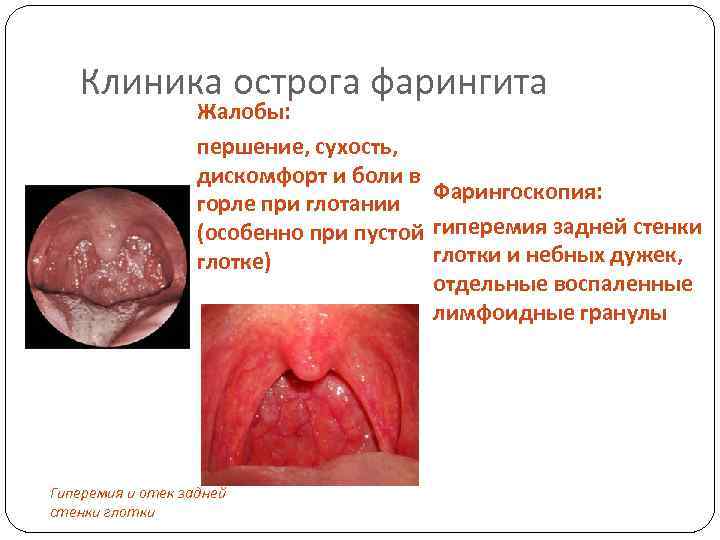 Клиника острога фарингита Жалобы: першение, сухость, дискомфорт и боли в Фарингоскопия: горле при глотании