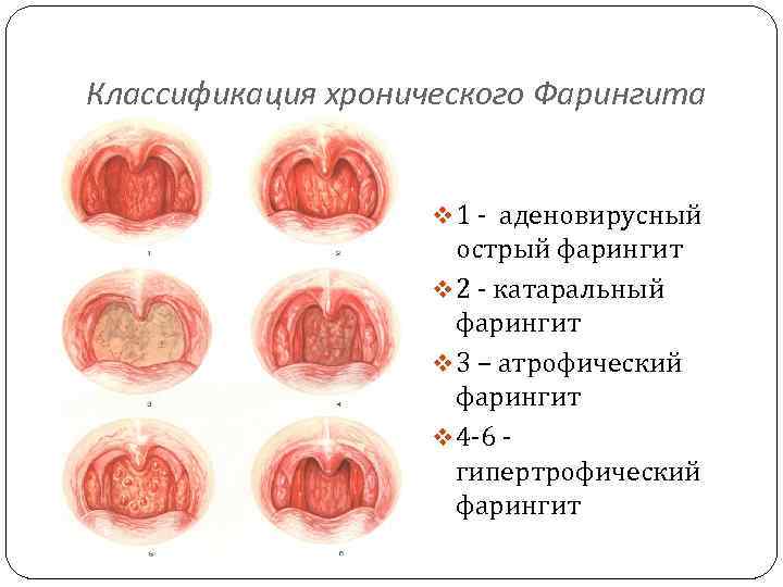 Классификация хронического Фарингита v 1 - аденовирусный острый фарингит v 2 - катаральный фарингит