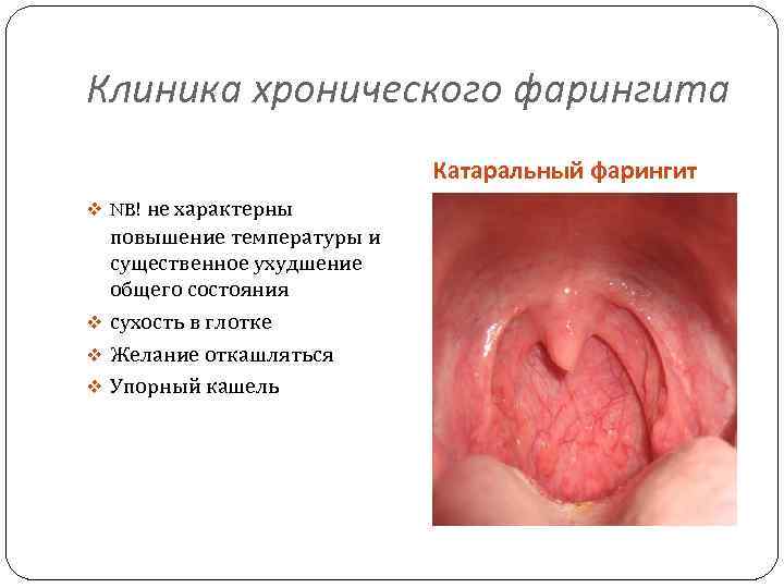 Клиника хронического фарингита Катаральный фарингит v NB! не характерны повышение температуры и существенное ухудшение