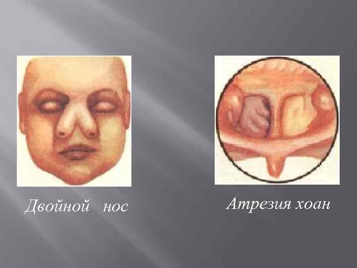 Двойной нос Атрезия хоан 