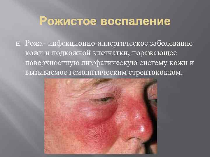 Рожистое воспаление Рожа- инфекционно-аллергическое заболевание кожи и подкожной клетчатки, поражающее поверхностную лимфатическую систему кожи