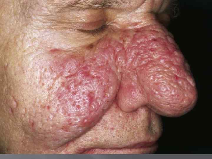  Предраспологающие факторы: алкоголь, пряности, перегревание или переохлаждение носа , понижение иммунитета. Изначально появляются