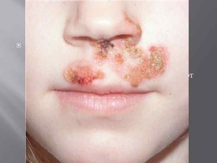  Лечение амбулаторное , пораженную кожу обрабатывают борной или салициловой кислотой и заклыдывают в