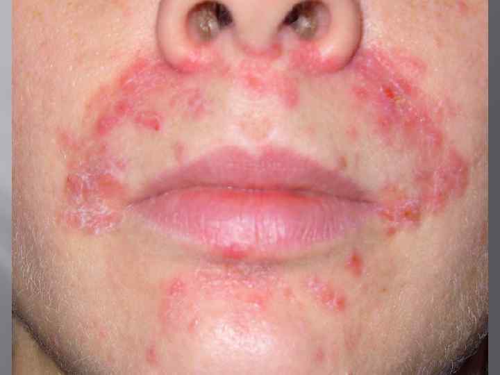 Экзема носа Хроническое рецидивирующее вооспалительное заболевание кожи носа с острым воспалительными изменениями и полиморфными