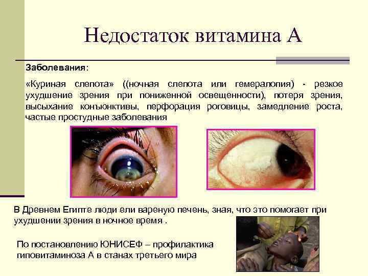 Недостаток витамина А Заболевания: «Куриная слепота» ((ночная слепота или гемералопия) - резкое ухудшение зрения