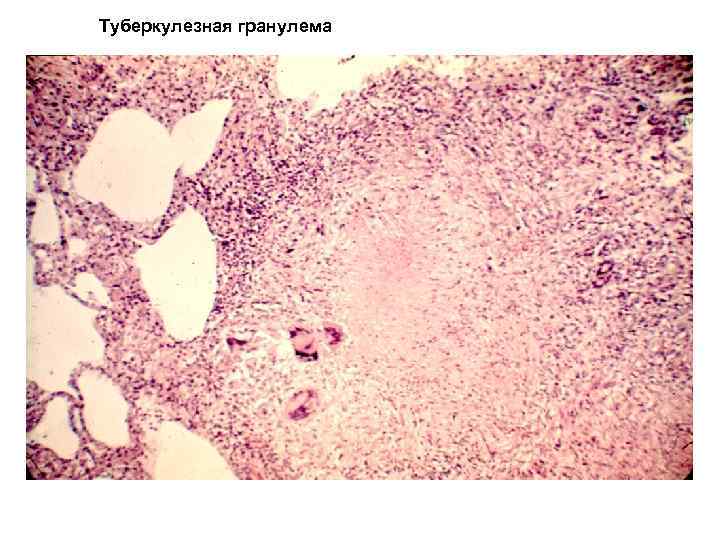 Туберкулезная гранулема 