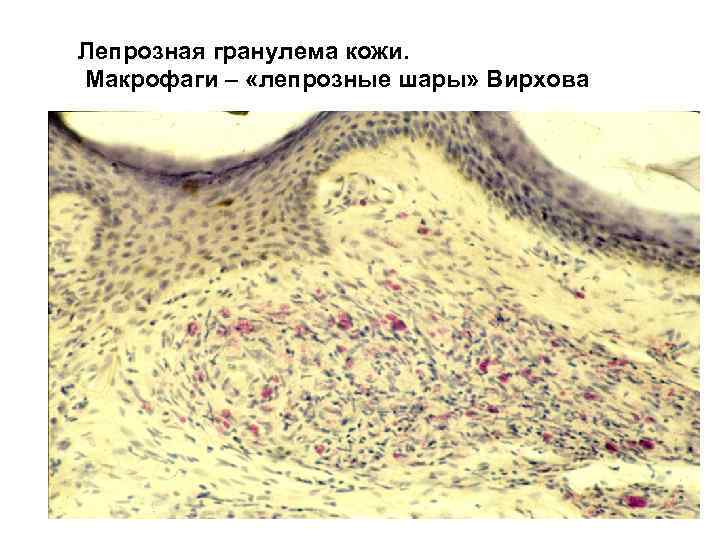 Лепрозная гранулема кожи. Макрофаги – «лепрозные шары» Вирхова 