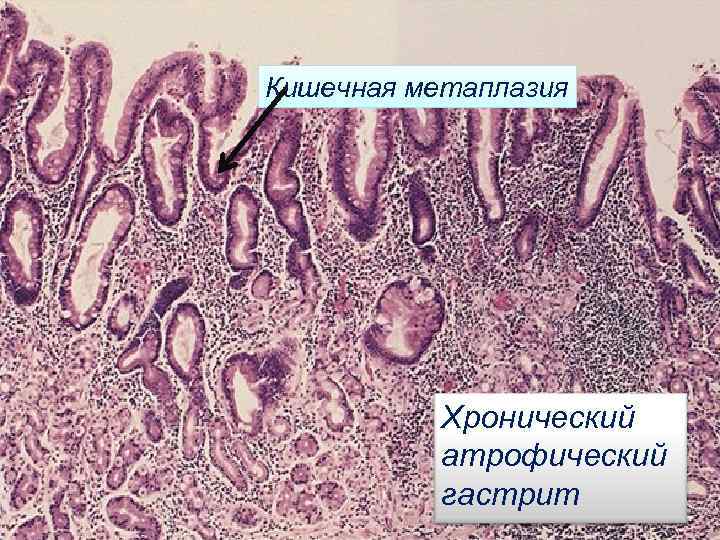 Кишечная метаплазия Хронический атрофический гастрит 