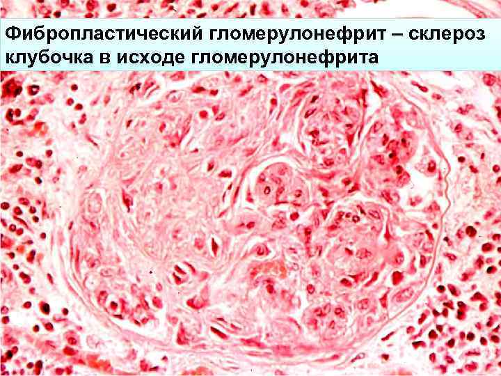 Фибропластический гломерулонефрит – склероз клубочка в исходе гломерулонефрита 