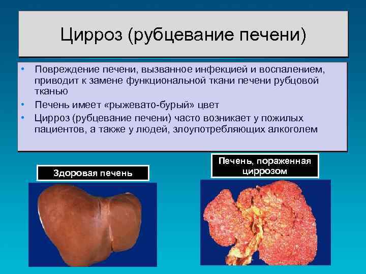 Цирроз (рубцевание печени) • Повреждение печени, вызванное инфекцией и воспалением, приводит к замене функциональной