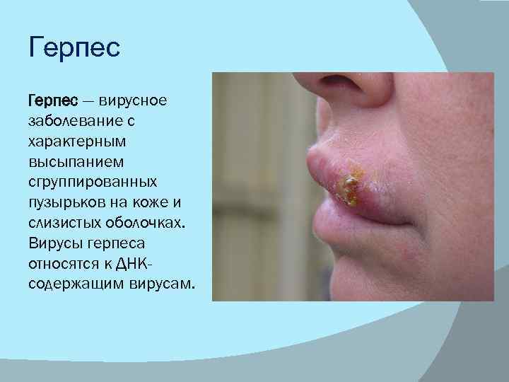 Герпес — вирусное заболевание с характерным высыпанием сгруппированных пузырьков на коже и слизистых оболочках.