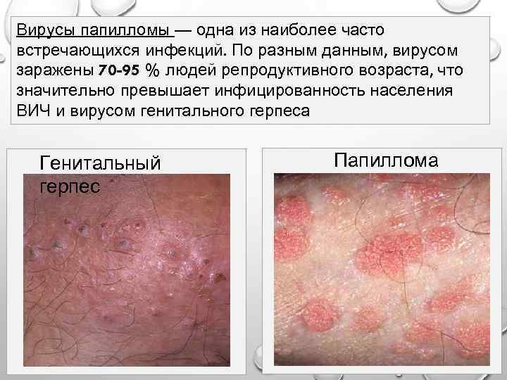 Вирусы папилломы — одна из наиболее часто встречающихся инфекций. По разным данным, вирусом заражены