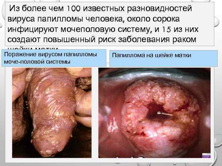 Из более чем 100 известных разновидностей вируса папилломы человека, около сорока инфицируют мочеполовую систему,