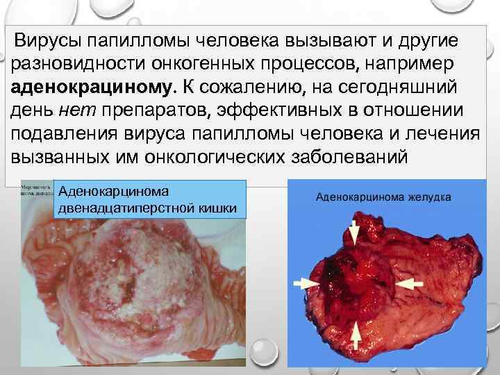 Вирусы папилломы человека вызывают и другие разновидности онкогенных процессов, например аденокрациному. К сожалению, на