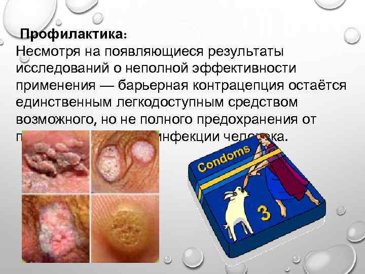 Профилактика: Несмотря на появляющиеся результаты исследований о неполной эффективности применения — барьерная контрацепция остаётся
