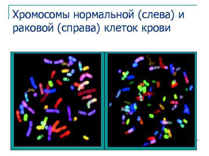 Хромосомы нормальной (слева) и раковой (справа) клеток крови 